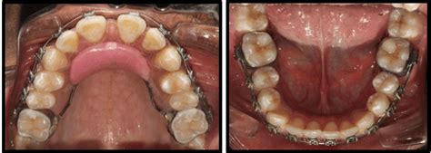 Treatment Intraoral Photographs With Nance Palatal Arch For Habit