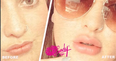 Natural Lip Fillers Outrageous Before And After Photos 4 Candylipz