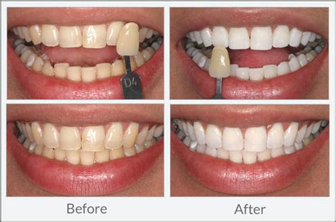 Teeth Whitening Dental Excellence