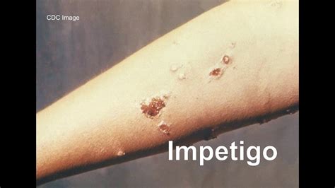 Impetigo Youtube