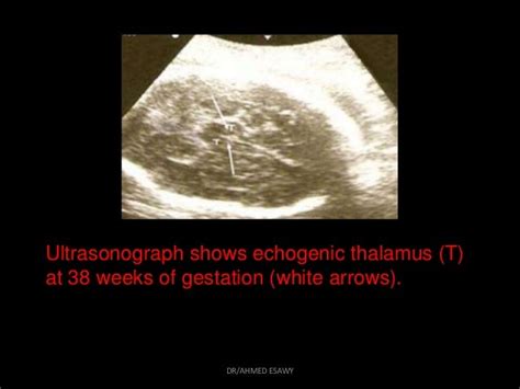 8 Fetal Chest Dr Ahmed Esawy