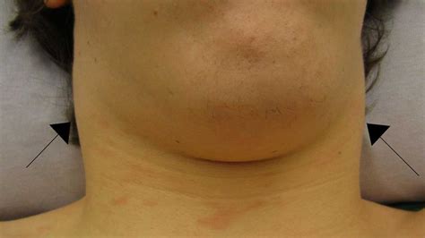 Neck Lump Pictures Causes Associated Symptoms And More Swollen