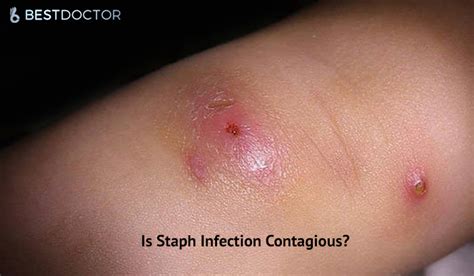 Mild Staph Infection