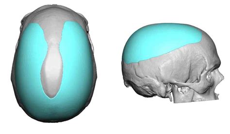 Blog Archivecase Study Sagittal Crest Head Reshaping