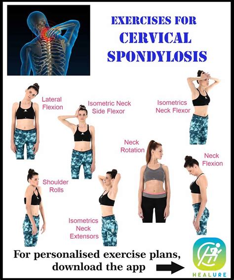 Neck Strengthening Exercises For Cervical Spondylosis Exercise Poster The Best Porn Website