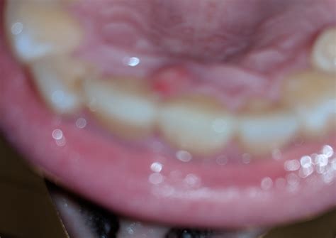 Painful Bump At Sight Of Roof Of Mouth Injection Dentistry