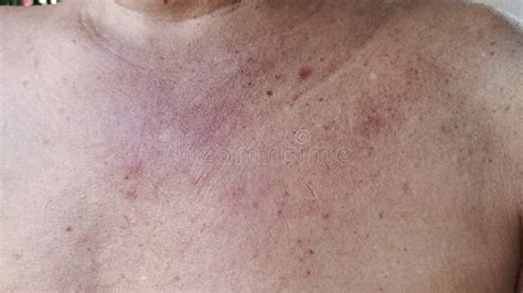 Dryness Skin Infections Allergic Reactions And Rash On The Body