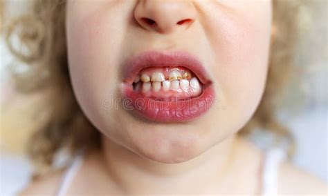Caries And Plaque On Children S Teeth Stock Image Image Of Open