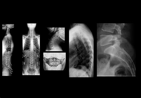Columna Vertebral Radiografía Estándar Anatomía Normal E Anatomy