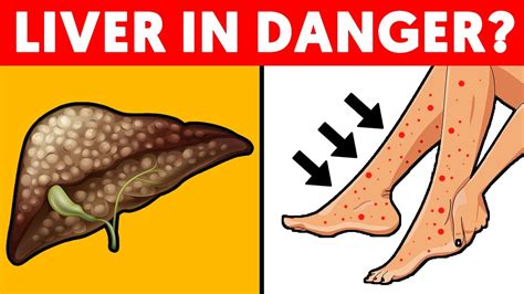 5 Signs Of Liver Problems Hidden In Your Feet Youtube