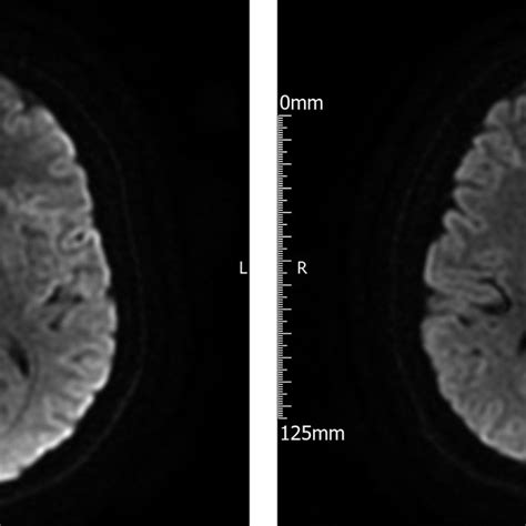 Magnetic Resonance Diffusion Weighted Imaging Showing Acute Infarcts In Download Scientific