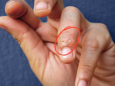 Hand Interdigital Dermatitis Dyshidrotic Eczema Hand Close Stock Photo Hot Sex Picture