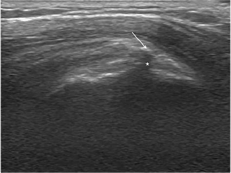 Sonographic Finding Of Calcific Tendinitis Of The Rotator Cuff The