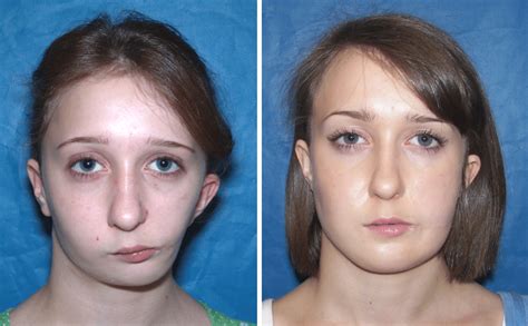 Before And After Case 25 Hemifacial Microsomia Surgery Dr Larry M
