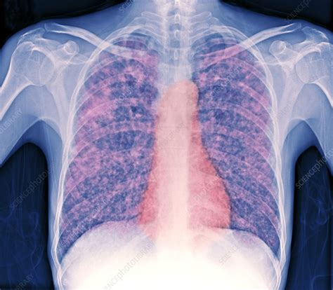 Tuberculosis X Ray Stock Image M2700250 Science Photo Library