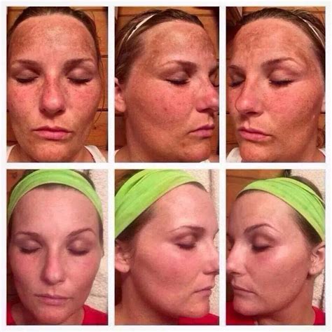 Rf Reverse Before Is July After Is December Rodan And Fields Laser