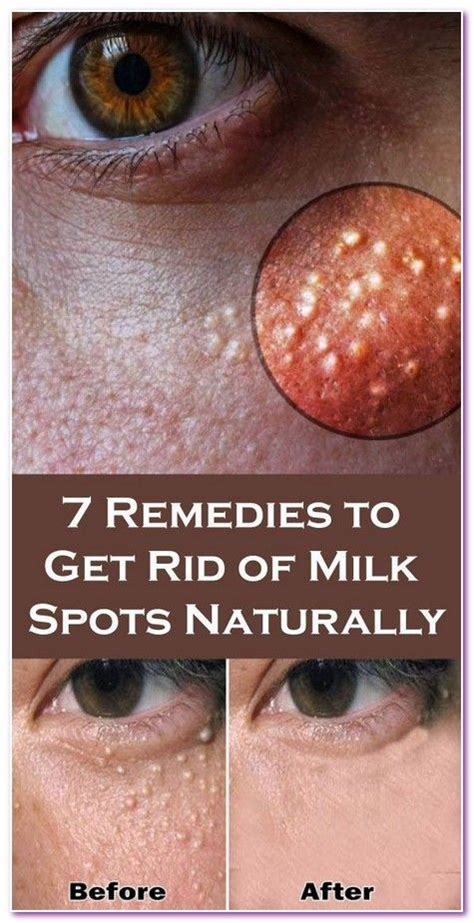7 Remedies To Get Rid Of Milk Spots Naturally Remedies Healthy Tips