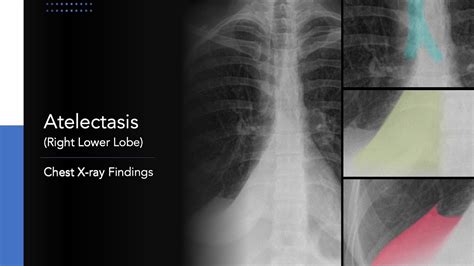 Atelectasis Right Lower Lobe Explanation Of Chest X Ray Findings