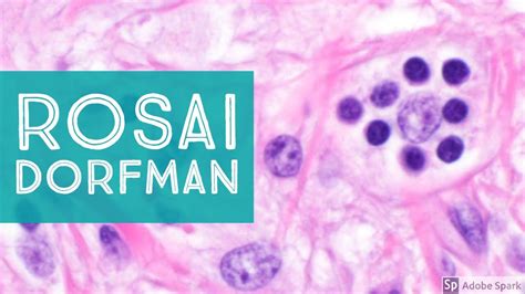 Extranodal Rosai Dorfman Disease 101explained By A Pathologist Youtube