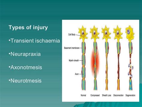Types Of Injury Transient Ischaemia Neurapraxia