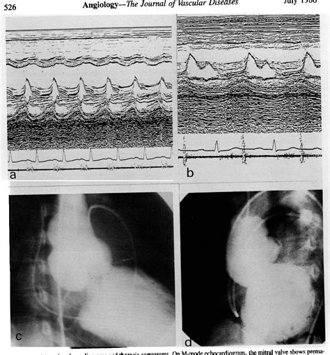 Figure 1 From Successful Treatment Of Acute Severe Aortic