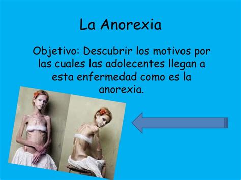 La Anorexia