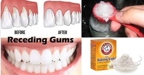 6 Natural Ways To Stop And Heal Receding Gums Before Its Too Late Don
