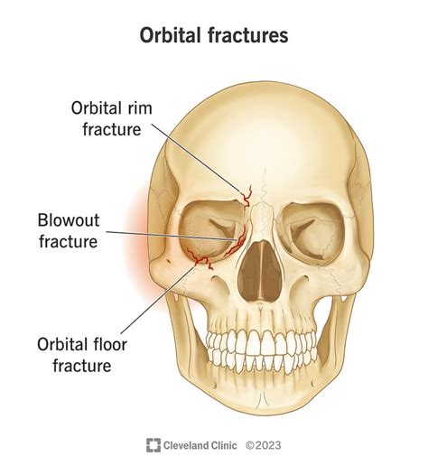 Orbital Fractures Symptoms Diagnosis And Treatment Bmj Best Practice