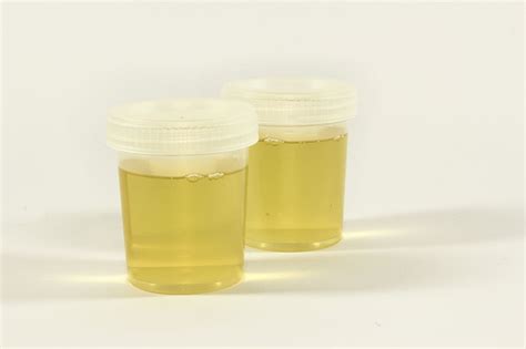 Causes Of Mucus In Urine