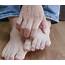 What Are The Symptoms Of Athletes Foot