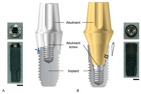 Prosthesis Free Full Text Influence Of Implantabutment Connection