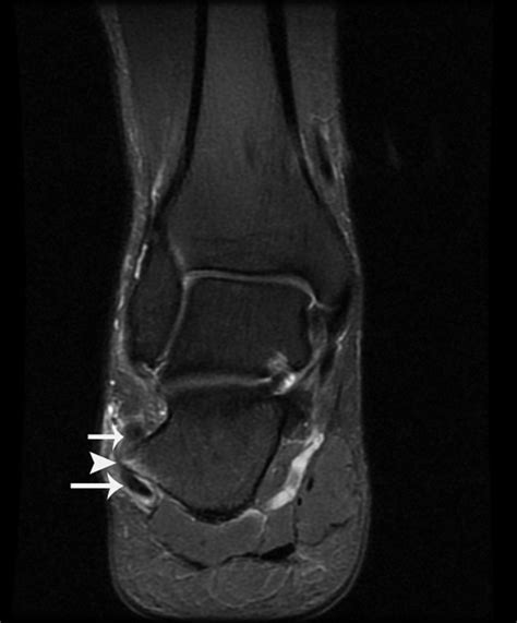 Tenosynovitis Of The Peroneal Tendons Associated With A Hypertrophic