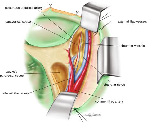 Nerve Sparing Radical Hysterectomy With Pelvic Lymphadenectomy Obgyn Key