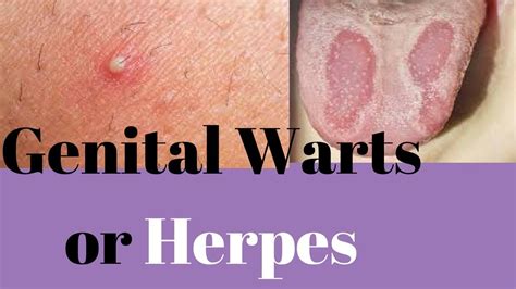 Genital Warts Or Herpes Similarities And Differences Of Genital Warts