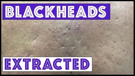 Were These Blackheads And Cysts From Agent Orange Exposure Youtube