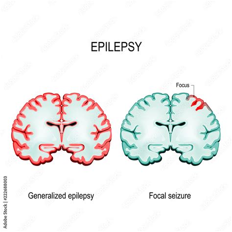 Primary Generalized Epilepsy And Focal Seizures Stock Vector Adobe Stock