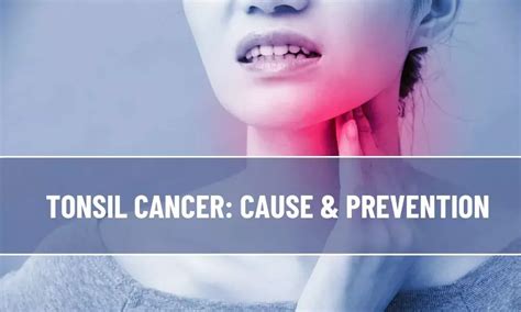 Tonsil Cancer Cause And Prevention Healthstory