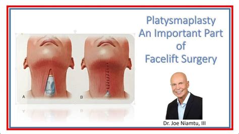 Platysmaplasty An Important Part Of Face And Neck Lift Surgery