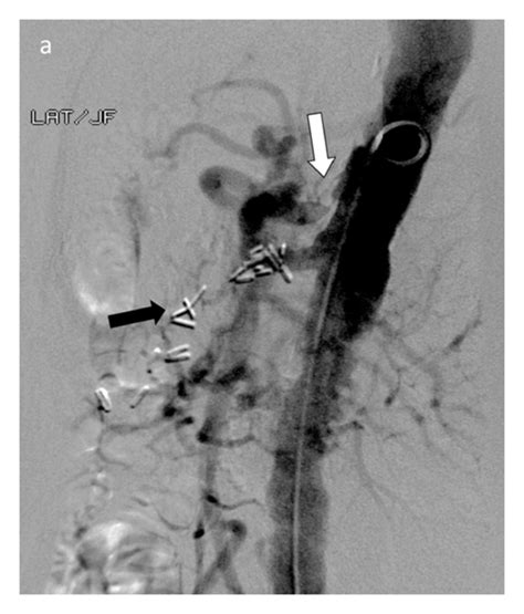 A Aortogram Demonstrates A Tight Stenosis Of The Proximal Celiac Axis