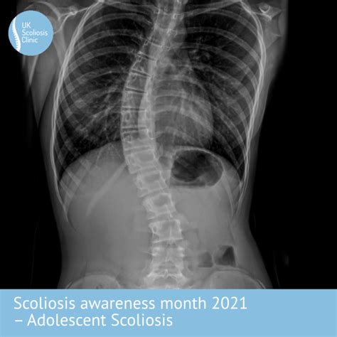Scoli2021 Ais Scoliosis Clinic Uk Treating Scoliosis Without Surgery