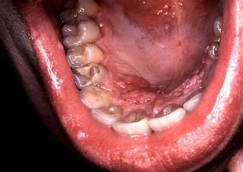 Mouth Cancer From Hpv Virus Reaches All Time High