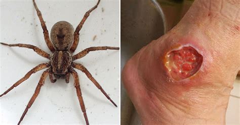 The Worst Spider Bite Pictures Including The Brown Recluse And Black