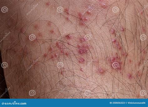 Allergic Reactions To Tick Bites Stock Image Image Of Dangerous