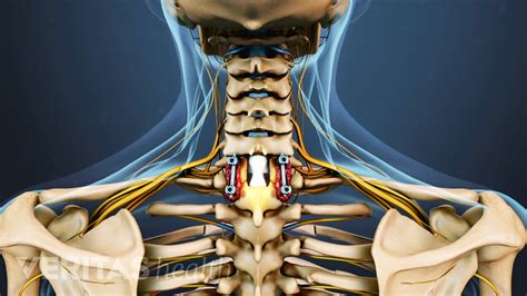 A Step By Step Guide To Cervical Laminectomy Surgery