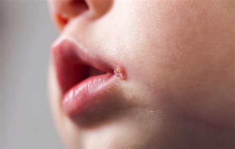 Are Cold Sores Contagious How Long Are Cold Sores Contagious