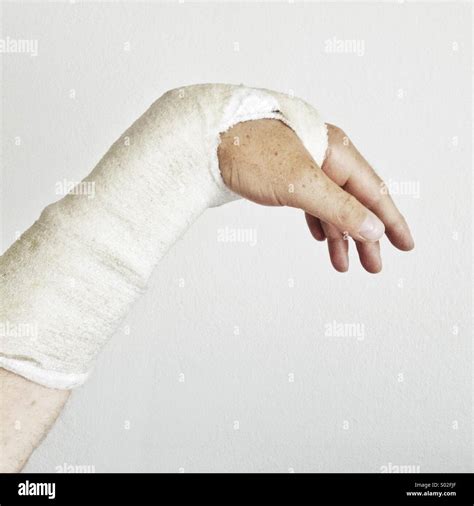 Plaster Cast Hi Res Stock Photography And Images Alamy