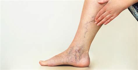 Swollen Legs Varicose Veins Or A Tight Feeling In Your