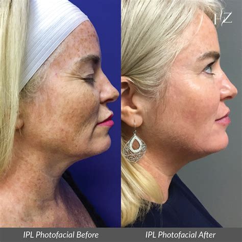 Ipl Photofacial Before And After Ipl Photofacial Photofacial Plastic