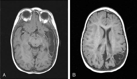 Mri Of The Brain Performed At 12 Months Of Age An Axial T1 Weighted