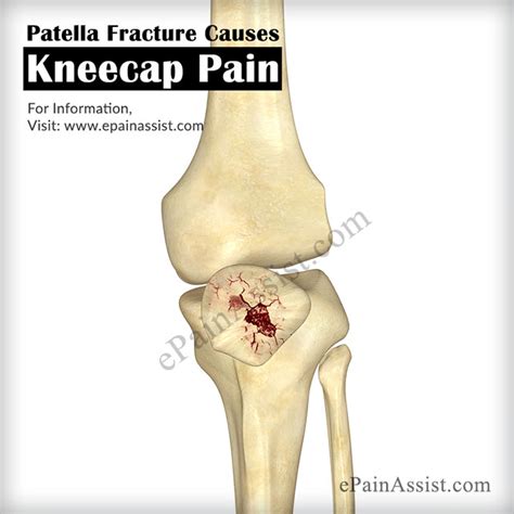 Kneecap Paincausessymptomstreatmentrecovery Periodbraceshome